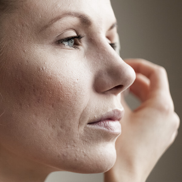 acne e cicatrizes